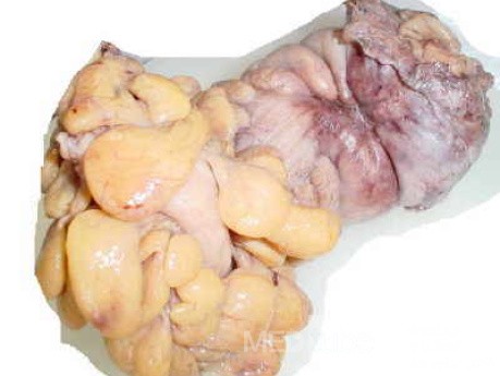 Rectal Adenocarcinoma (2 of 7)