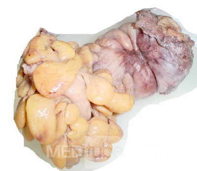 Rectal Adenocarcinoma (2 of 7)