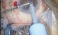 Cataract Surgery - Phacoemulsification - Acrysof Toric IOL