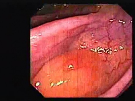 Colonic Lipoma (2 of 4)