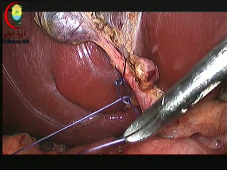 Cystic Duct Control with Suture Ligation