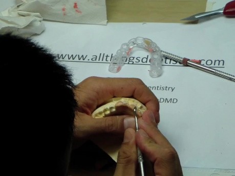 Anterior Waxup Correction - Part 1