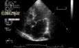 Infective Endocarditis:Chordal Rupture Of The Posterior Mitral Leaflet With Flail Mitral Valve