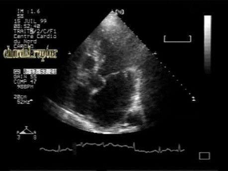 Infective Endocarditis:Chordal Rupture Of The Posterior Mitral Leaflet With Flail Mitral Valve