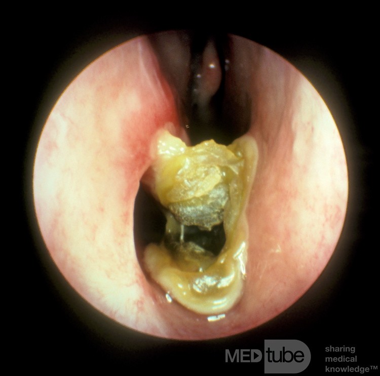 Iatrogenic Atrophic Rhinitis