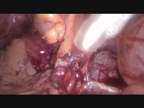 Laparoscopic Assisted Left Hemicolectomy Extended to Abdominal Wall and Renal Fatty Tissue for Locally Advanced Cancer of the Descending Colon