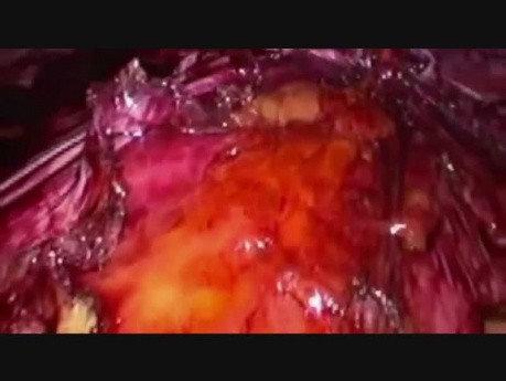 Laparoscopic E-Tep Rives Stoppa Repair with Right TAR