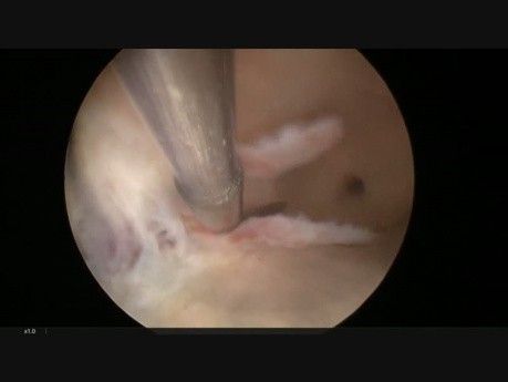 Hysteroscopic Metroplasty with Cold Scissors