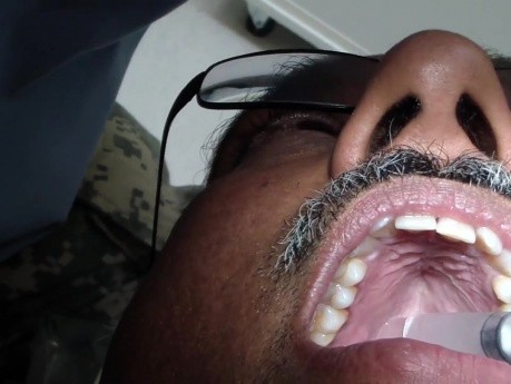 Greater Palatine Anesthesia With Ice - Take 5