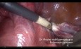 Hysterectomy with Vascular Omental Adhesions