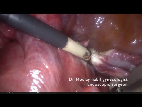 Hysterectomy with Vascular Omental Adhesions