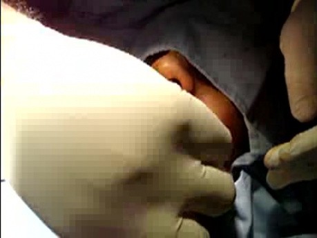 Hair transplantation surgical video