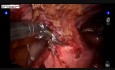 Davinci Robotic Adhesiolysis Surgery with Application of Interceed
