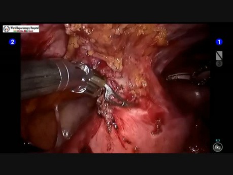 Davinci Robotic Adhesiolysis Surgery with Application of Interceed