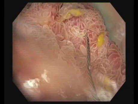 Endoscopic Polypectomy