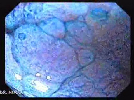 Chromoendoscopy Of The Esophagus - Magnified Multi-lobulated Papilloma - 1/4