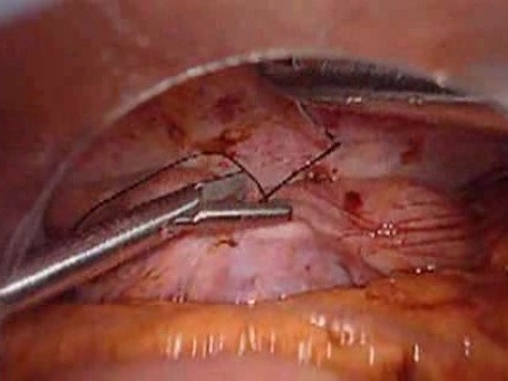 Colonic Perforation With Peritonitis - Laparoscopy (17 of 46)