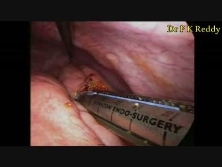 Laparoscopic Choledochal Cyst Excision with Hepaticojejunostomy 