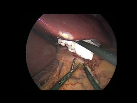 Pouch Confection in Gastric Sleeve Conversion to RYGB