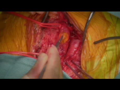 Left Atrial Myxoma Embolism to the Descending Aorta