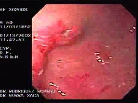 Cyst-Gastrostomy (3 of 5)