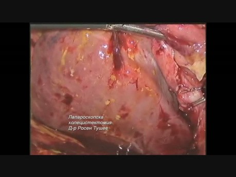 Laparoscopic Cholecystectomy