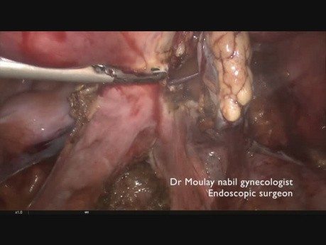 Safe, Fast, Bloodless Sacrocolpopexy for Genital Prolaps
