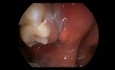 Mouth Boils - Buccoalveolar Sulcus