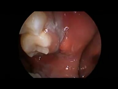 Mouth Boils - Buccoalveolar Sulcus