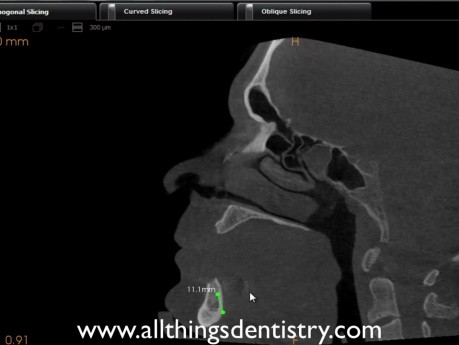 Mandibular Implant Placement - Review Of 2 Implant Case