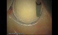 Final Preparation For Aesthetic Veneers (4/4)