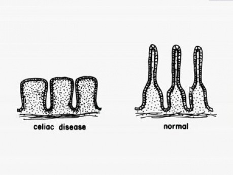 Celiac sprue - Histopathology - Small intestine