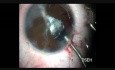 IOL Implantation in a case of Disorganized Anterior Chamber