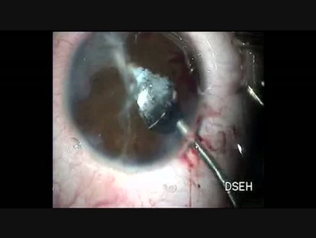 IOL Implantation in a case of Disorganized Anterior Chamber