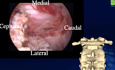 Unilateral Biportal Endoscopic Posterior Cervical Laminectomy and Discectomy 