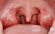 Normal Tonsils