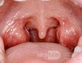 Normal Tonsils