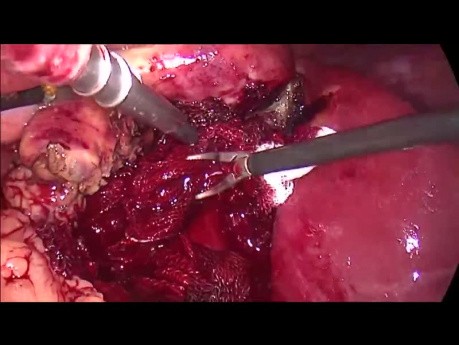 Laparoscopic Cholecystectomy for Cholecystitis. Management of Bleeding from Gallbladder Bed