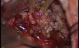 Petroclival Meningioma - Right-Retrosigmoid Approach