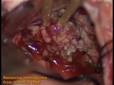 Petroclival Meningioma - Right-Retrosigmoid Approach