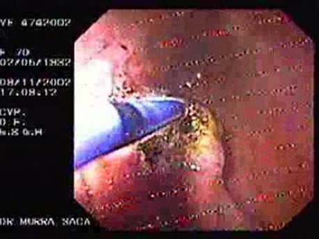 Dieulafoy´s Lesion (Exulceratio Simplex) (8 of 11)