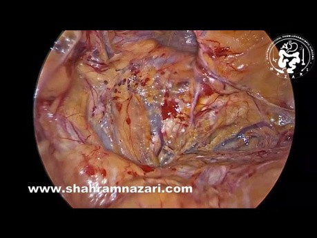 Left Recurrent Inguinal Hernia Repair