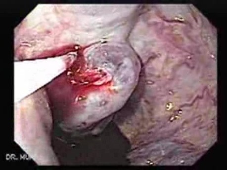 Severe Variceal Bleeding - Sclerotherapy