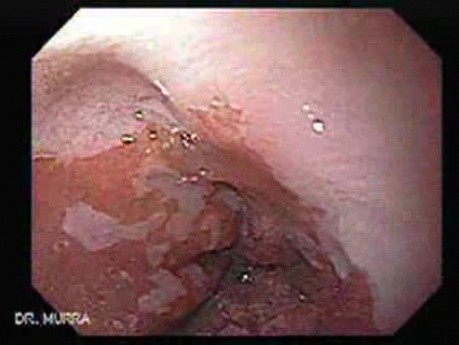 Barrett Esophagus - Endoscopic Close View