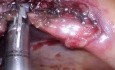LESS Cholecystectomy Undertaken with Epidural Anesthesia in lieu of General Anesthesia