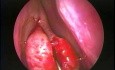 Concha Bullosa Resection