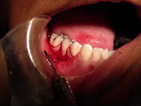 Part 2/8: Root Coverage Surgery - Mandibular Premolar - Mid Surgery