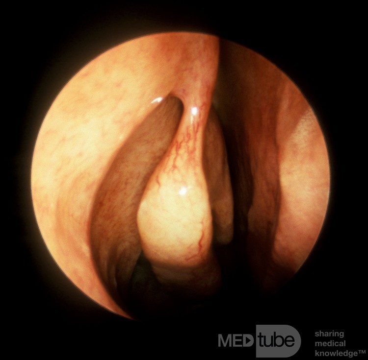 Normal Uncinate Process [right]