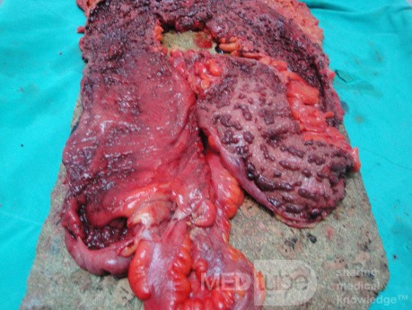 Multiple Rectal Ulcers (82 of 110)