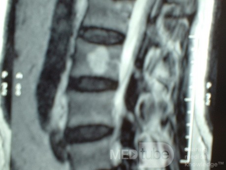 Hemangioma